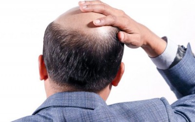 hair-transplant-in-Meerut