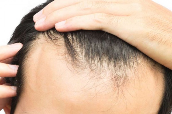 hair-loss-treatment