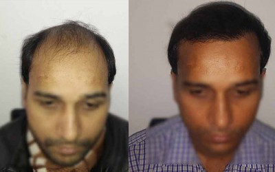 Hair Transplant in Delhi