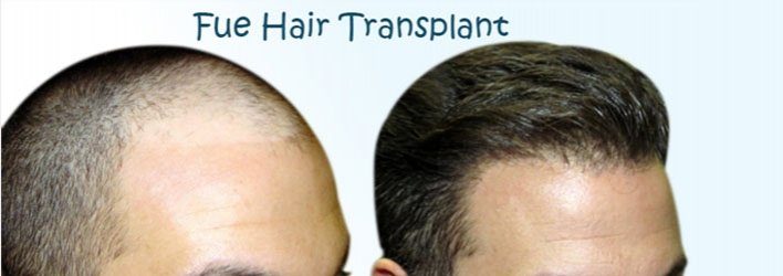 fue hair transplant in Delhi